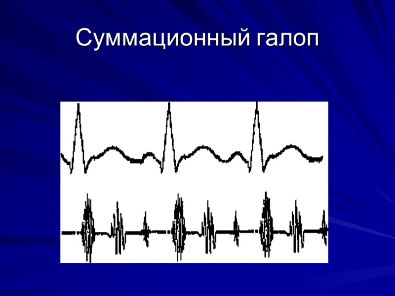 Суммационный галоп Суммационный галоп